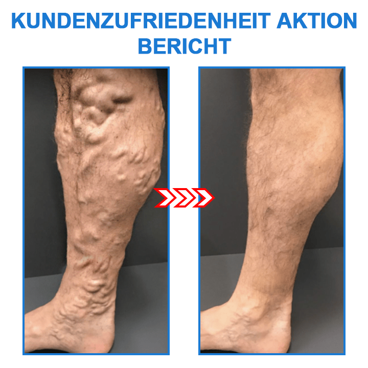 TourmaCare™ – Straffere Haut & Weniger Cellulite | Jetzt 1+1 Gratis!