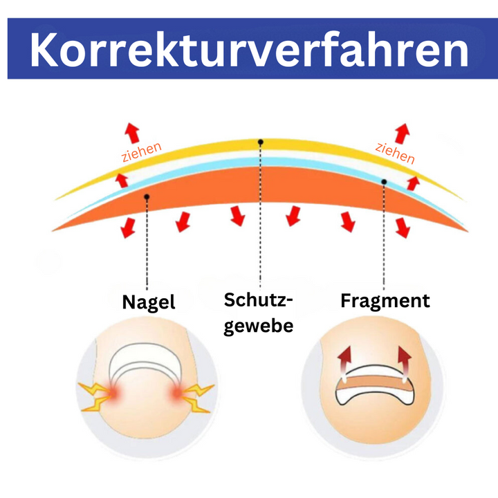 ToeCare™ – Effektive Hilfe bei eingewachsenen Zehennägeln