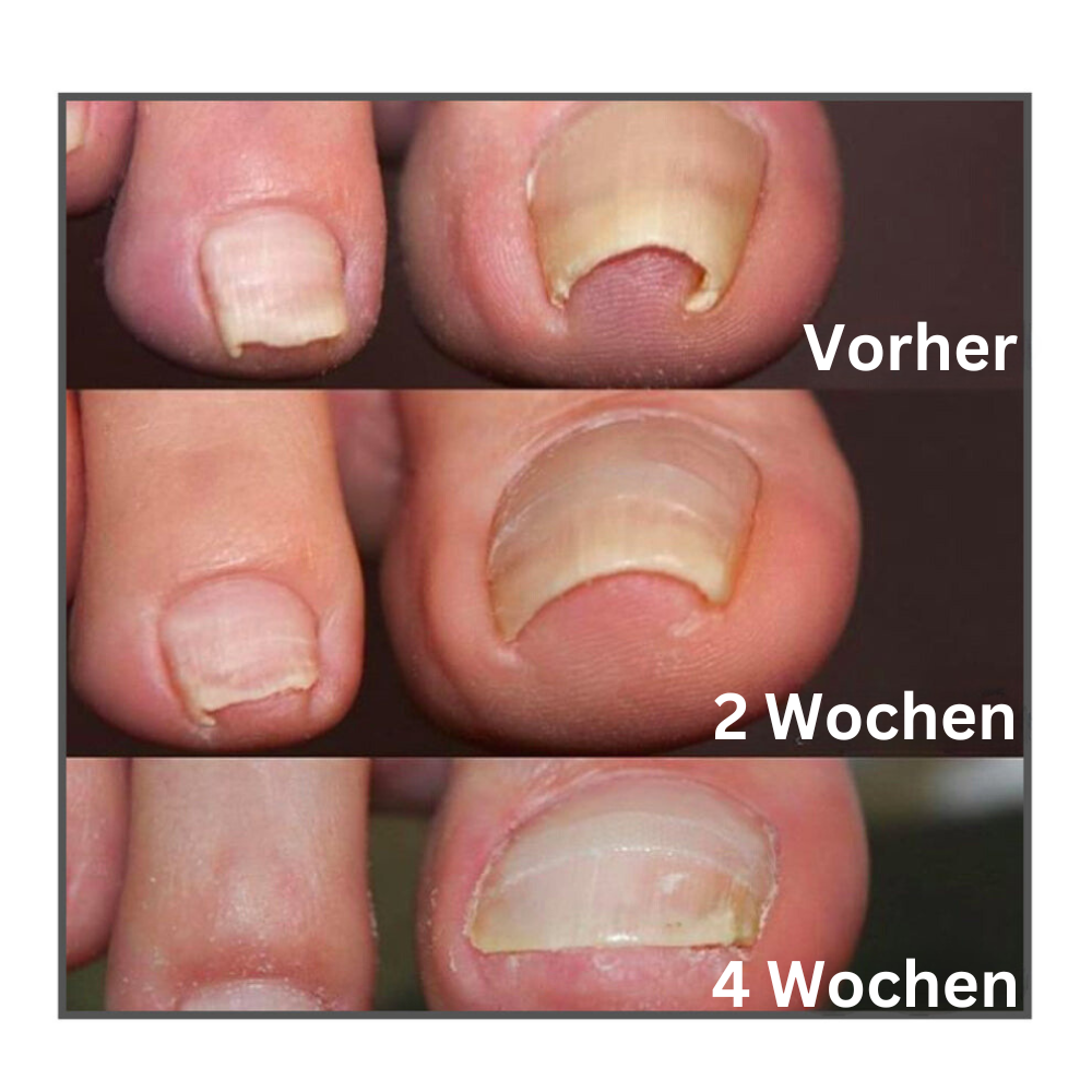 ToeCare™ – Effektive Hilfe bei eingewachsenen Zehennägeln