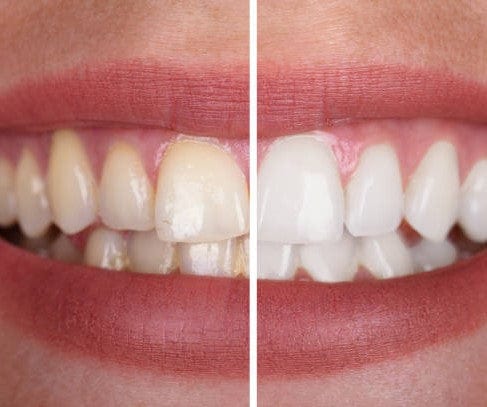 BeautySmile™  genießen Sie ein strahlend weißes Lächeln ohne Risiko!